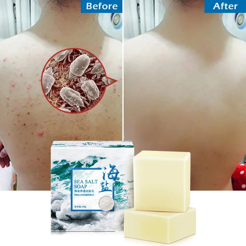 Sea Salt Soap - Whitening and Moisturizing Acne Treatment Bar