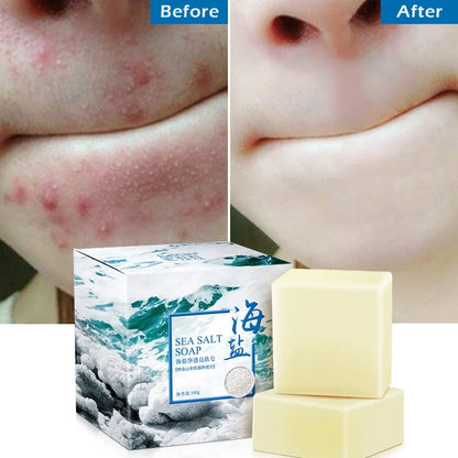 Sea Salt Soap - Whitening and Moisturizing Acne Treatment Bar
